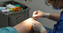Not Ready for a Knee Replacement? A Minimally Invasive Procedure May Ease Chronic Pain Without Joint Replacement